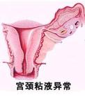 宫颈粘液异常的原因