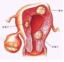 多囊卵巢综合症