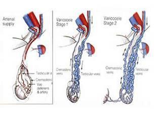 儿茶酚胺类物质在精索静脉曲张病理生理中的作用