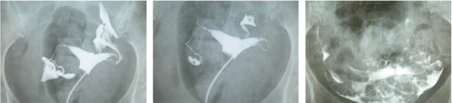 解读子宫输卵管造影片